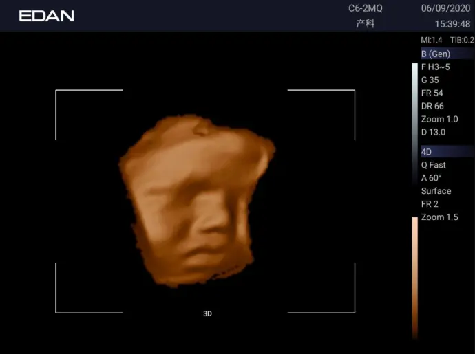 Edan AX3 en uso en consultorio médico portátil con transductor conectado